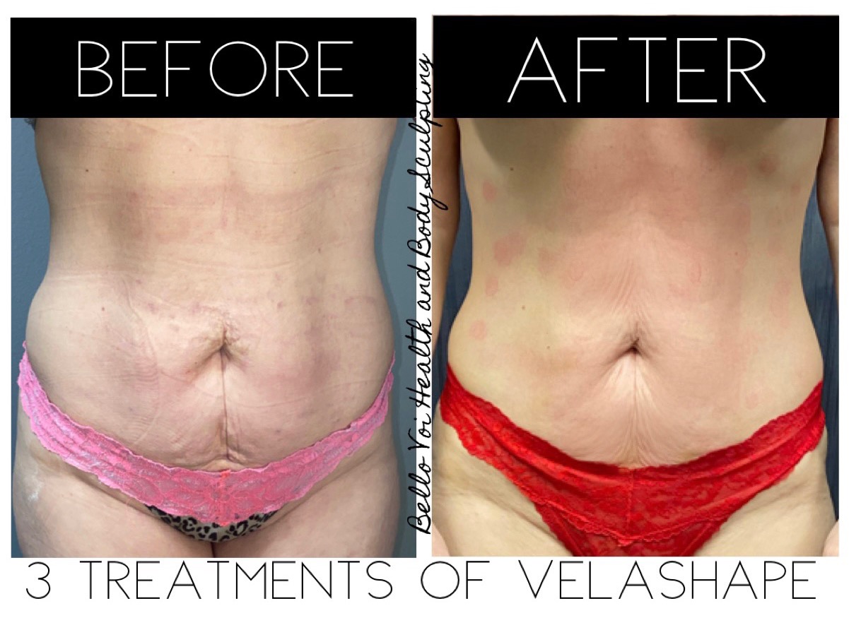 Red Light Therapy and Body Contouring at Bella Voi in Hammond